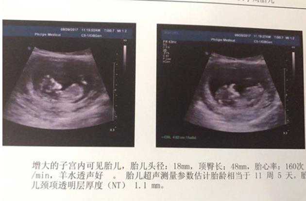 广东医院让捐卵 2022广东治疗单角子宫排名前十医院安利 ‘b超宝宝脊柱看男女
